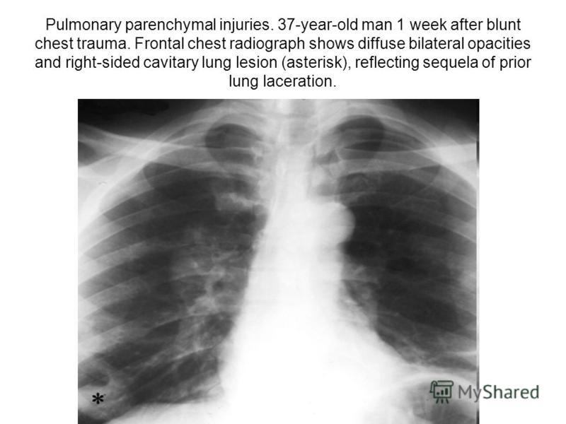 Pulmonary parenchymal injuries. 37-year-old man 1 week after blunt chest trauma. Frontal chest radiograph shows diffuse bilateral opacities and right-sided cavitary lung lesion (asterisk), reflecting sequela of prior lung laceration.
