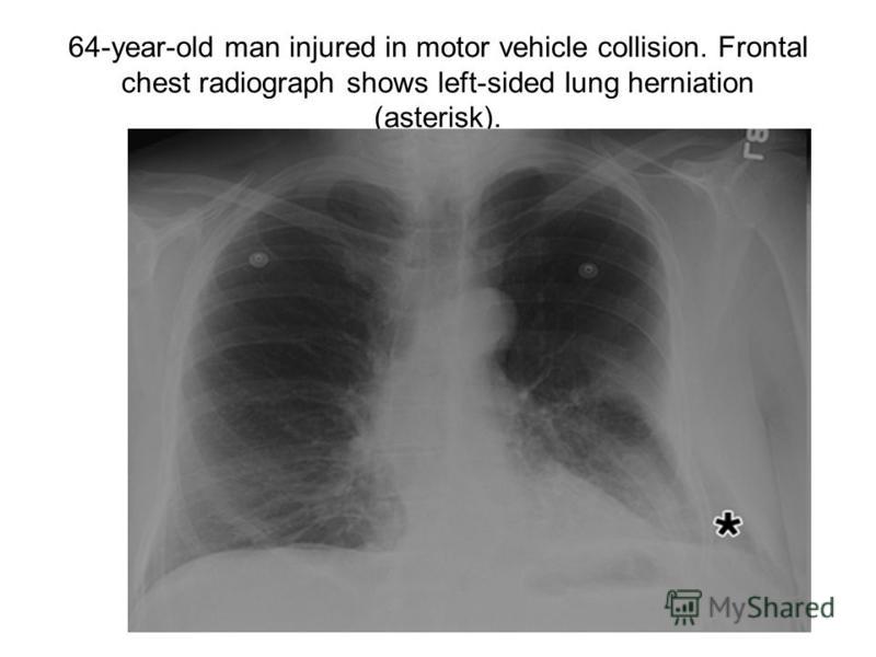 64-year-old man injured in motor vehicle collision. Frontal chest radiograph shows left-sided lung herniation (asterisk).