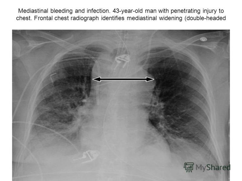 Mediastinal bleeding and infection. 43-year-old man with penetrating injury to chest. Frontal chest radiograph identifies mediastinal widening (double-headed arrow), suggestive of vascular injury.