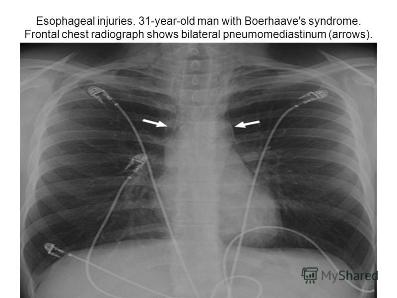 Esophageal injuries. 31-year-old man with Boerhaave's syndrome. Frontal chest radiograph shows bilateral pneumomediastinum (arrows).