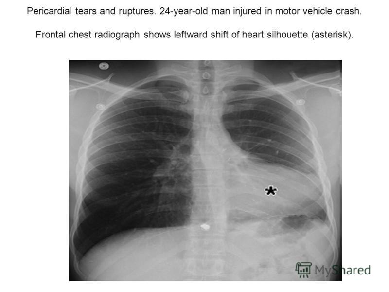 Pericardial tears and ruptures. 24-year-old man injured in motor vehicle crash. Frontal chest radiograph shows leftward shift of heart silhouette (asterisk).
