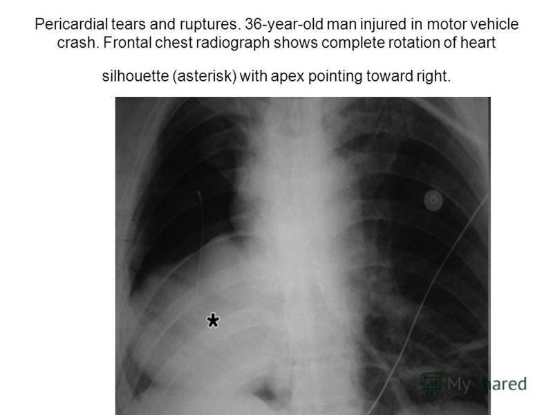 Pericardial tears and ruptures. 36-year-old man injured in motor vehicle crash. Frontal chest radiograph shows complete rotation of heart silhouette (asterisk) with apex pointing toward right.