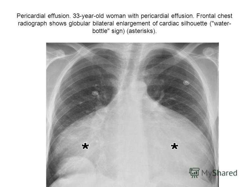 Pericardial effusion. 33-year-old woman with pericardial effusion. Frontal chest radiograph shows globular bilateral enlargement of cardiac silhouette (water- bottle sign) (asterisks).