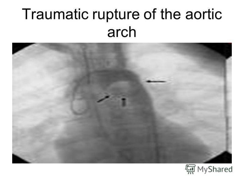Traumatic rupture of the aortic arch