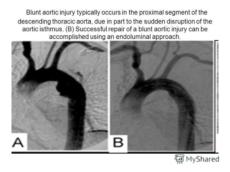 Blunt aortic injury typically occurs in the proximal segment of the descending thoracic aorta, due in part to the sudden disruption of the aortic isthmus. (B) Successful repair of a blunt aortic injury can be accomplished using an endoluminal approac