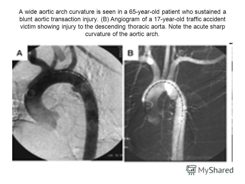 A wide aortic arch curvature is seen in a 65-year-old patient who sustained a blunt aortic transaction injury. (B) Angiogram of a 17-year-old traffic accident victim showing injury to the descending thoracic aorta. Note the acute sharp curvature of t