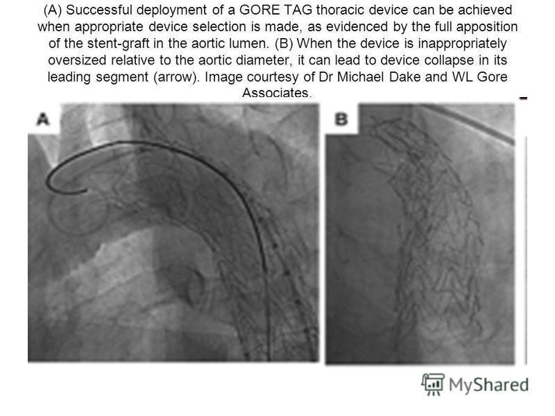 (A) Successful deployment of a GORE TAG thoracic device can be achieved when appropriate device selection is made, as evidenced by the full apposition of the stent-graft in the aortic lumen. (B) When the device is inappropriately oversized relative t