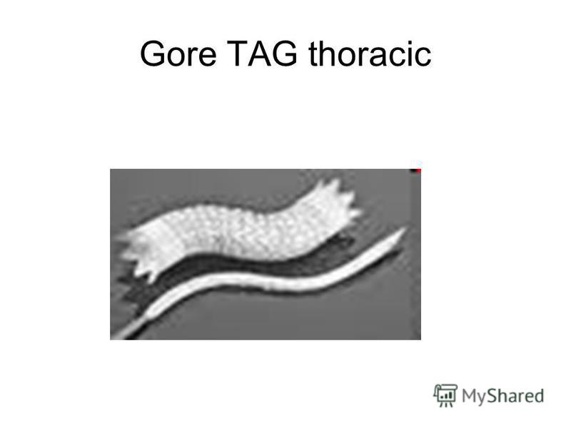 Gore TAG thoracic