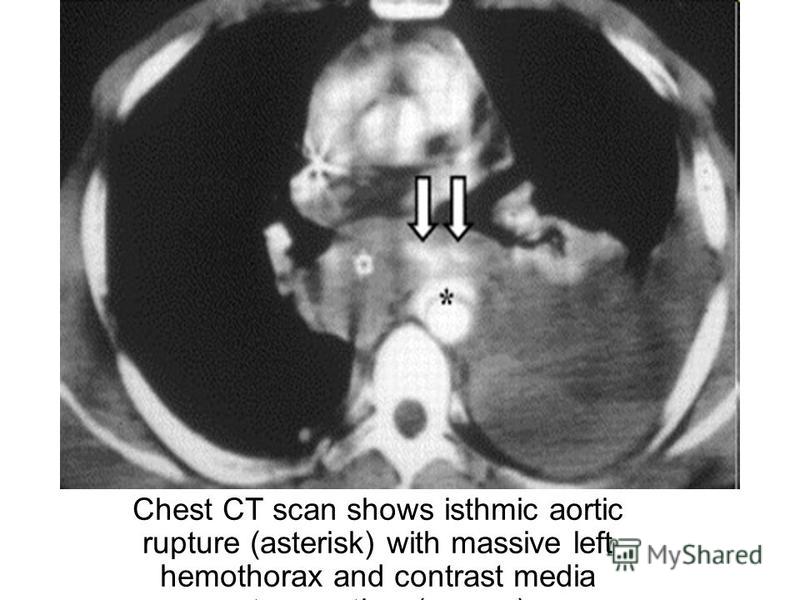 Chest CT scan shows isthmic aortic rupture (asterisk) with massive left hemothorax and contrast media extravasation (arrows).