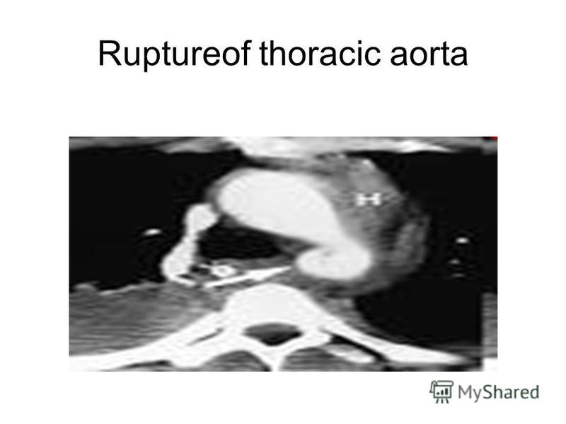 Ruptureof thoracic aorta
