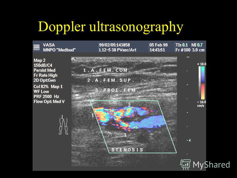 Doppler ultrasonography