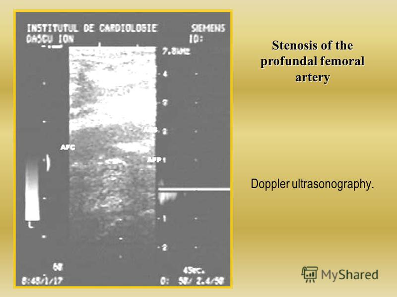 Stenosis of the profundal femoral artery Doppler ultrasonography.