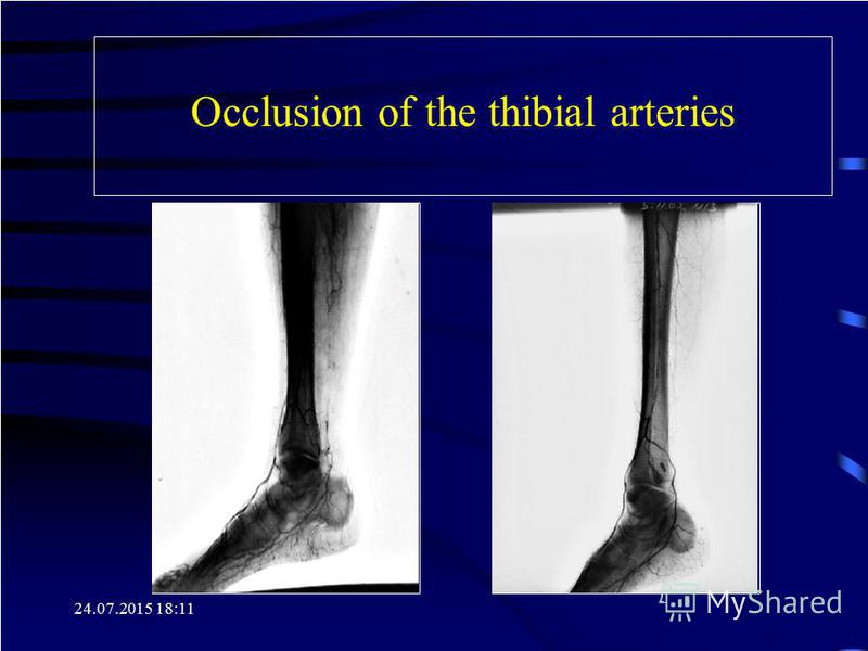 24.07.2015 18:12 Occlusion of the thibial arteries