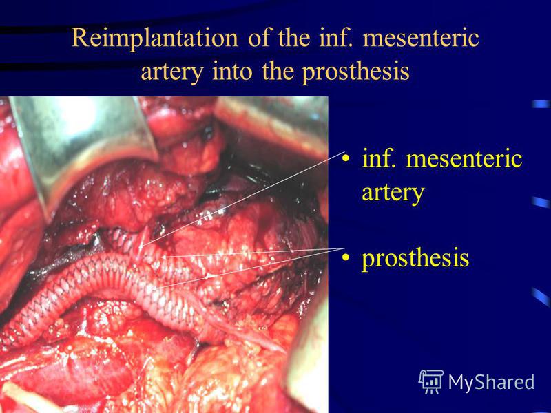 24.07.2015 18:12 Reimplantation of the inf. mesenteric artery into the prosthesis inf. mesenteric artery prosthesis