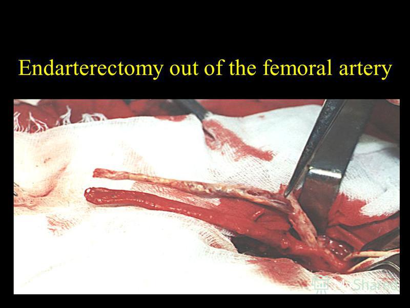 Endarterectomy out of the femoral artery
