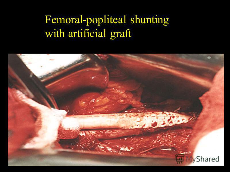 Femoral-popliteal shunting with artificial graft