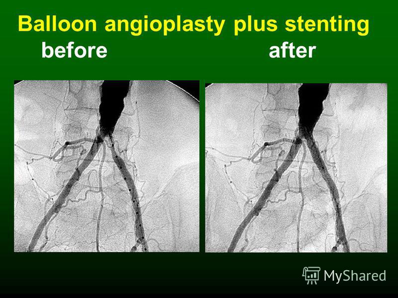 Balloon angioplasty plus stenting before after