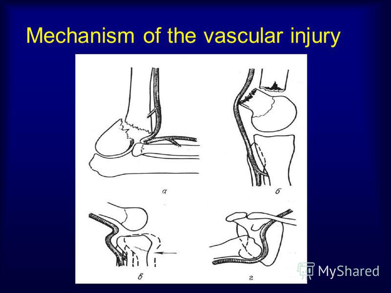 Mechanism of the vascular injury