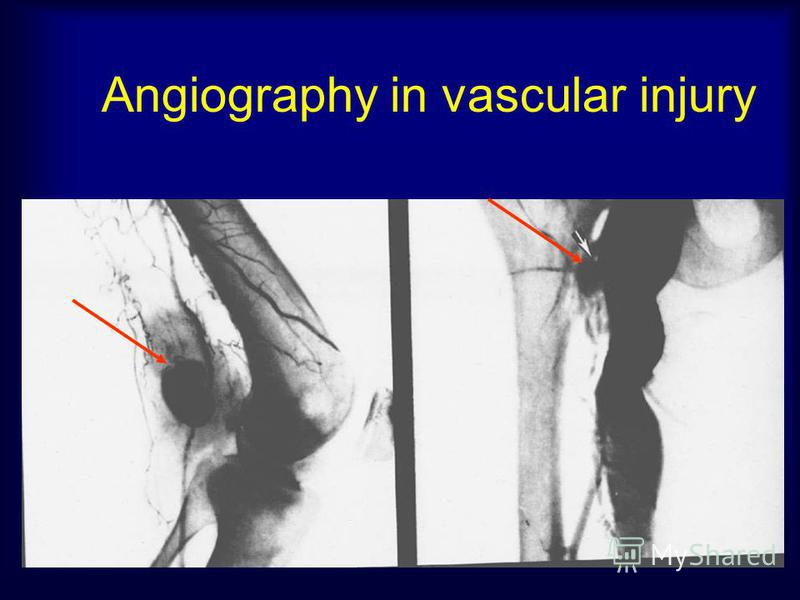 Angiography in vascular injury