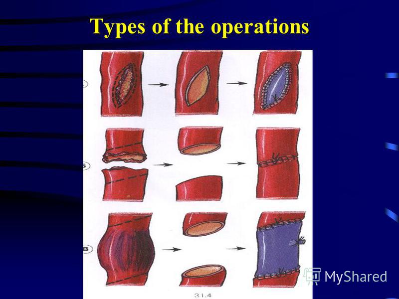 Types of the operations