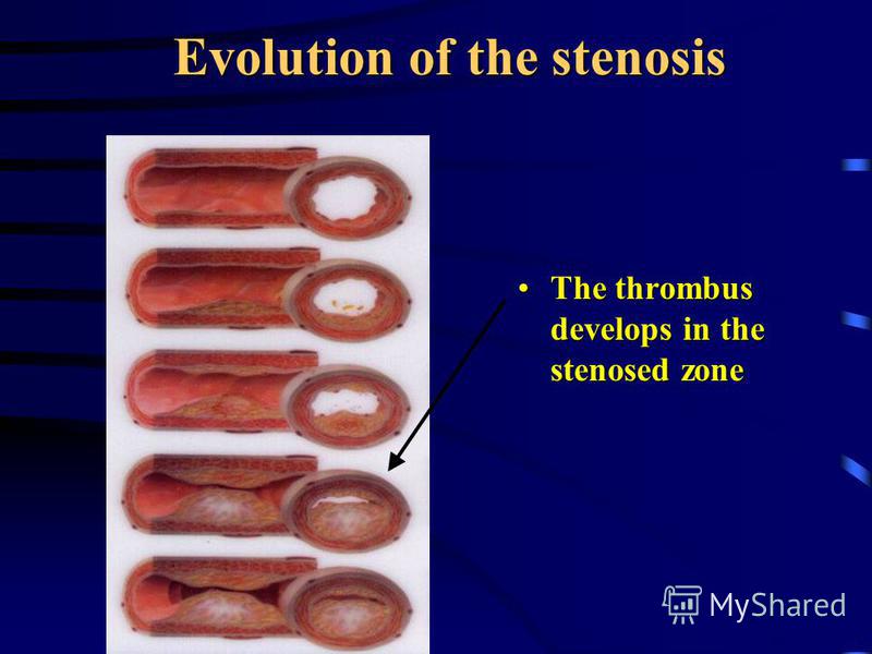 Evolution of the stenosis The thrombus develops in the stenosed zoneThe thrombus develops in the stenosed zone