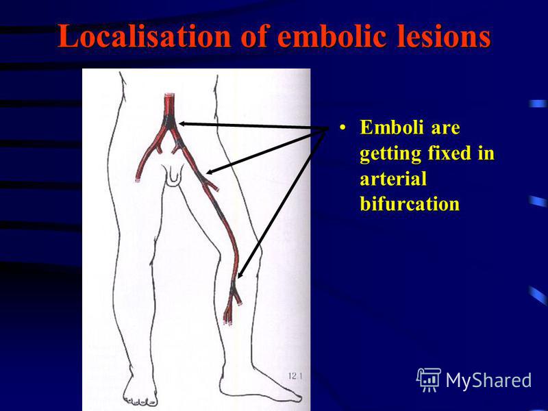Localisation of embolic lesions Emboli are getting fixed in arterial bifurcationEmboli are getting fixed in arterial bifurcation