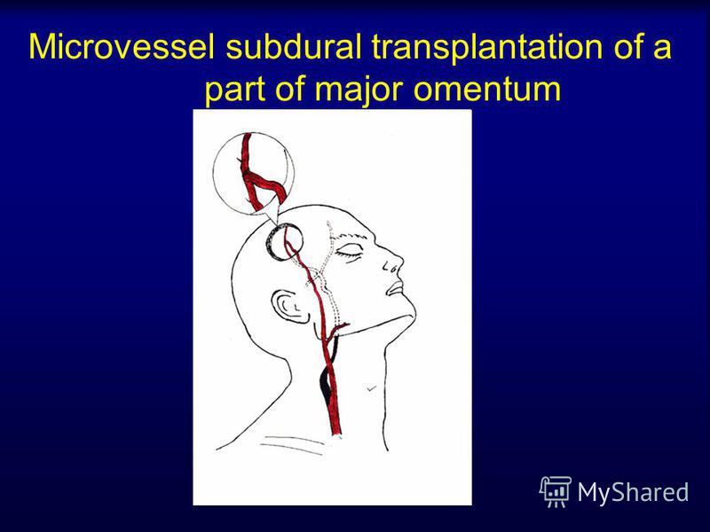 Microvessel subdural transplantation of a part of major omentum