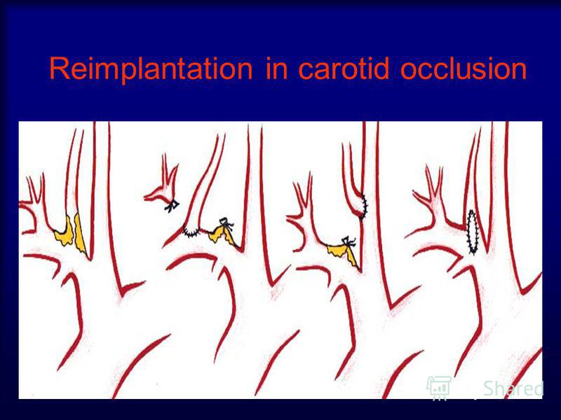 Reimplantation in carotid occlusion