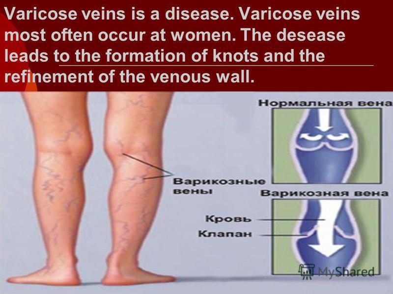 Varicose veins is a disease. Varicose veins most often occur at women. The desease leads to the formation of knots and the refinement of the venous wall.