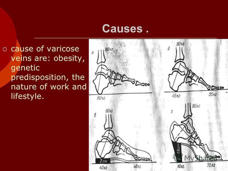 Causes. cause of varicose veins are: obesity, genetic predisposition, the nature of work and lifestyle.