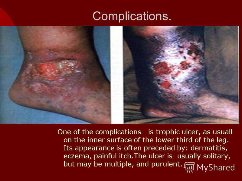 Complications. One of the complications is trophic ulcer, as usuall on the inner surface of the lower third of the leg. Its appearance is often preceded by: dermatitis, eczema, painful itch.The ulcer is usually solitary, but may be multiple, and puru