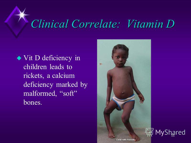 11 Clinical Correlate: Vitamin D u Vit D deficiency in children leads to rickets, a calcium deficiency marked by malformed, soft bones.