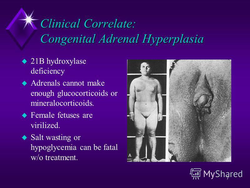 7 Clinical Correlate: Congenital Adrenal Hyperplasia u 21B hydroxylase deficiency u Adrenals cannot make enough glucocorticoids or mineralocorticoids. u Female fetuses are virilized. u Salt wasting or hypoglycemia can be fatal w/o treatment.