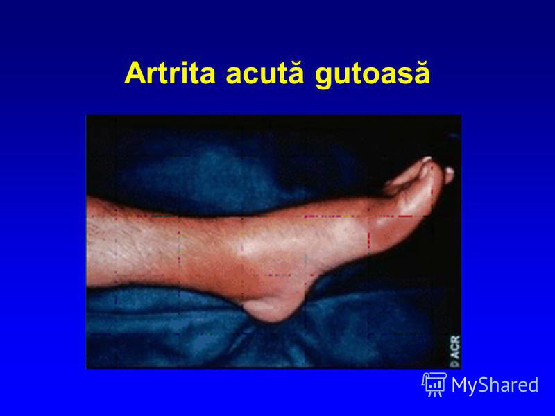 artroza gutoasă a gleznei