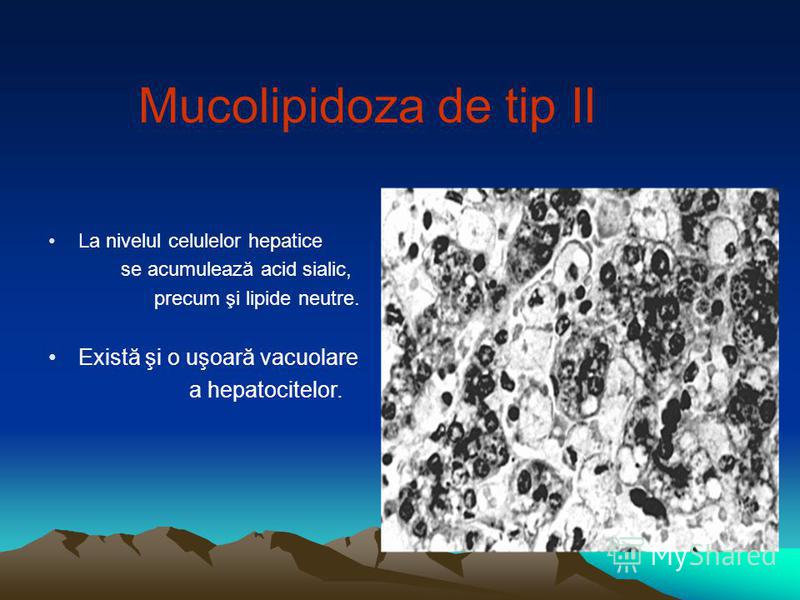 Mucolipidoza de tip II La nivelul celulelor hepatice se acumulează acid sialic, precum şi lipide neutre. Există şi o uşoară vacuolare a hepatocitelor.