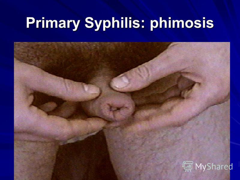 the clinical description of syphilis Secondary syphilis is the second stage of this highly contagious sexually transmitted infection learn about the symptoms and treatment options. the clinical description of syphilis Secondary syphilis is the second stage of this highly contagious sexually transmitted infection learn about the symptoms and treatment options.