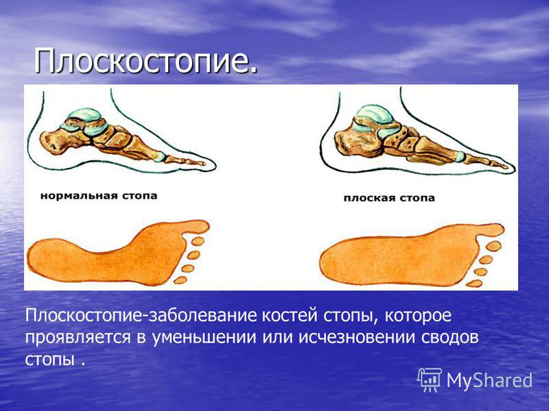 Плоскостопие. Плоскостопие-заболевание костей стопы, которое проявляется в уменьшении или исчезновении сводов стопы.