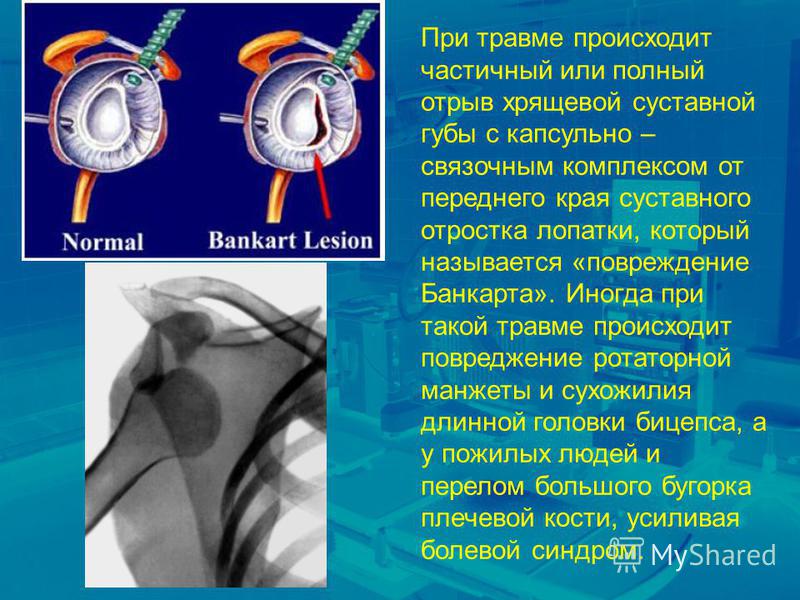 Плечевой сустав повреждение банкарта 13