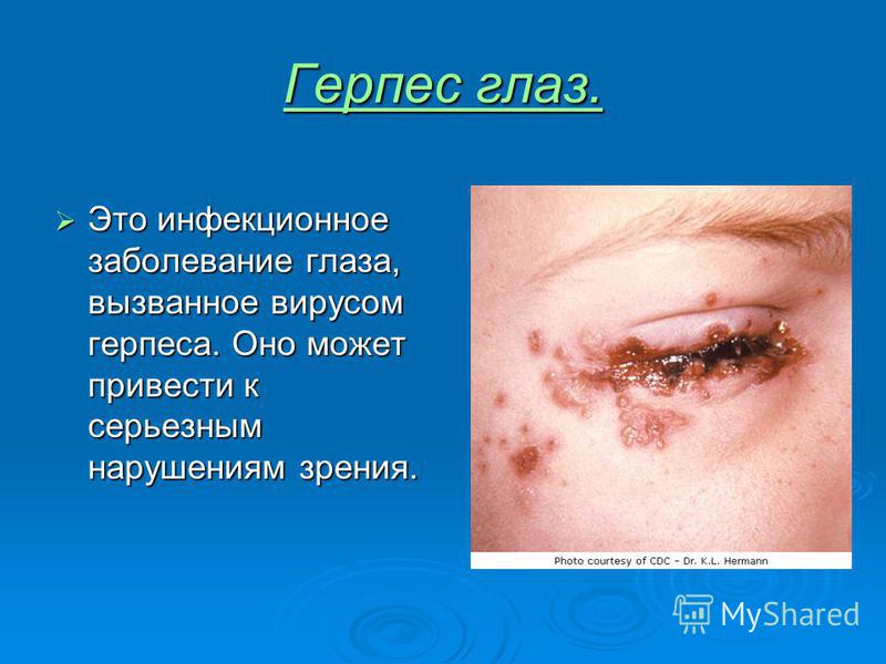 Герпес женские болезни Герпес женские болезни