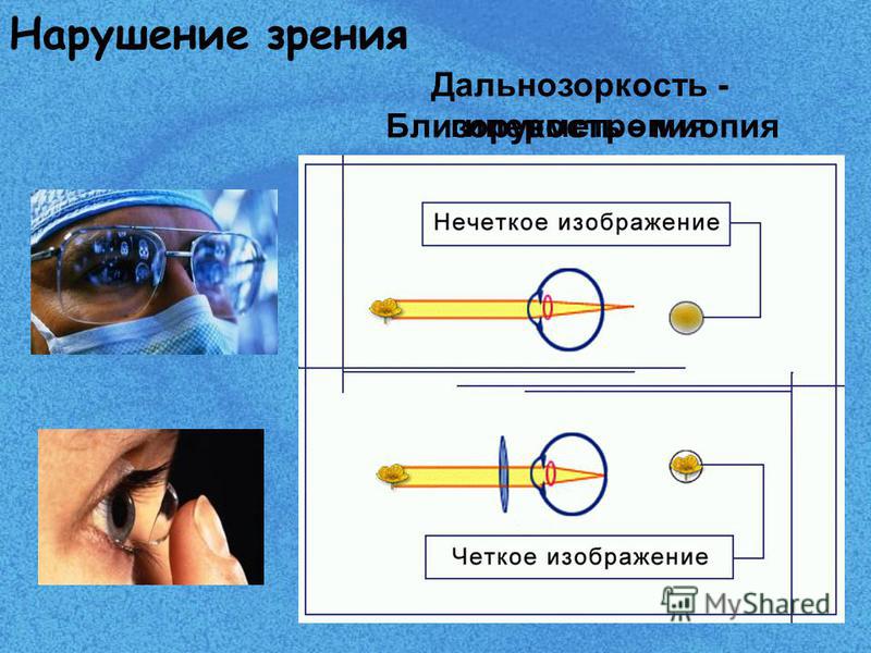 Тексты близорукость и дальнозоркость