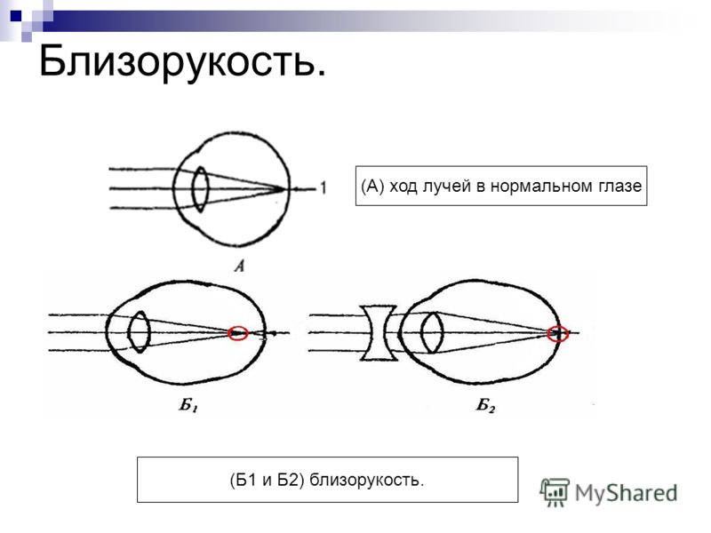 Лазерная коррекция зрение у меня минус 2