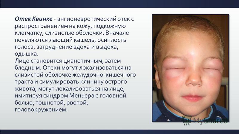 Как лечить при головокружение когда встаешь Как лечить при головокружение когда встаешь