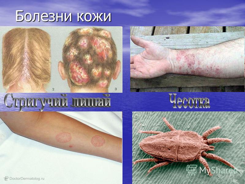 Кожа и подростковые заболевания кожи Кожа и подростковые заболевания кожи