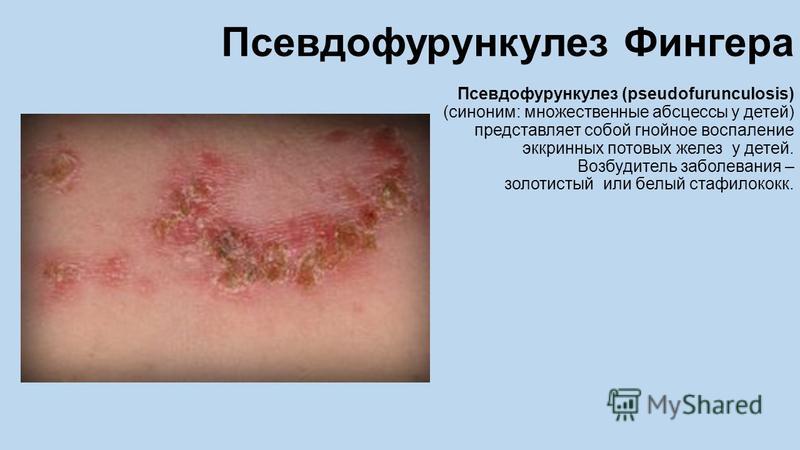 Стафилококк и воспаление на коже Стафилококк и воспаление на коже