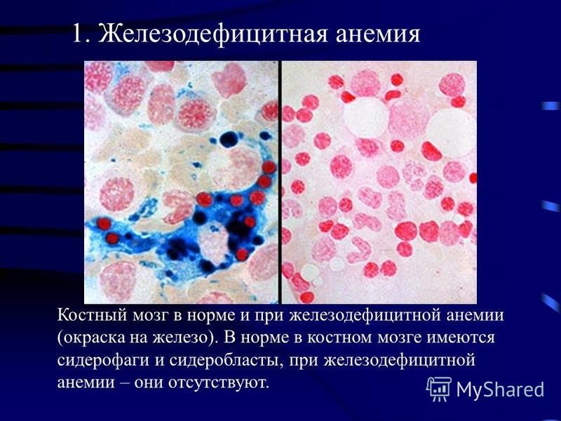 Хроническая железодефицитная анемия как лечить Хроническая железодефицитная анемия как лечить