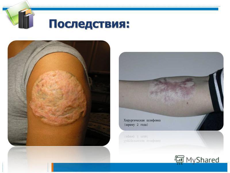 Осложнения при тату Осложнения при тату