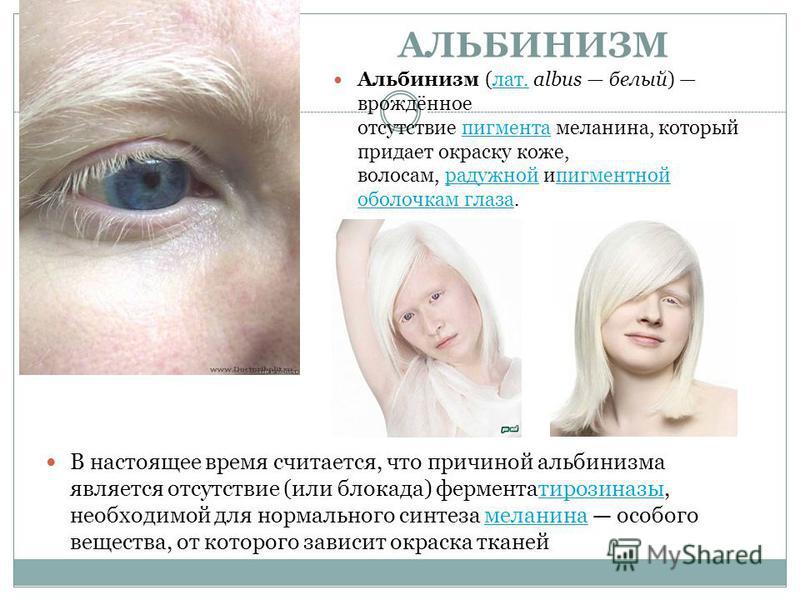 АЛЬБИНИЗМ Альбинизм (лат. albus белый) врождённое отсутствие пигмента меланина, который придает окраску коже, волосам, радужной пигментной оболочкам глаза.лат.пигментарадужнойпигментной оболочкам глаза В настоящее время считается, что причиной альбин