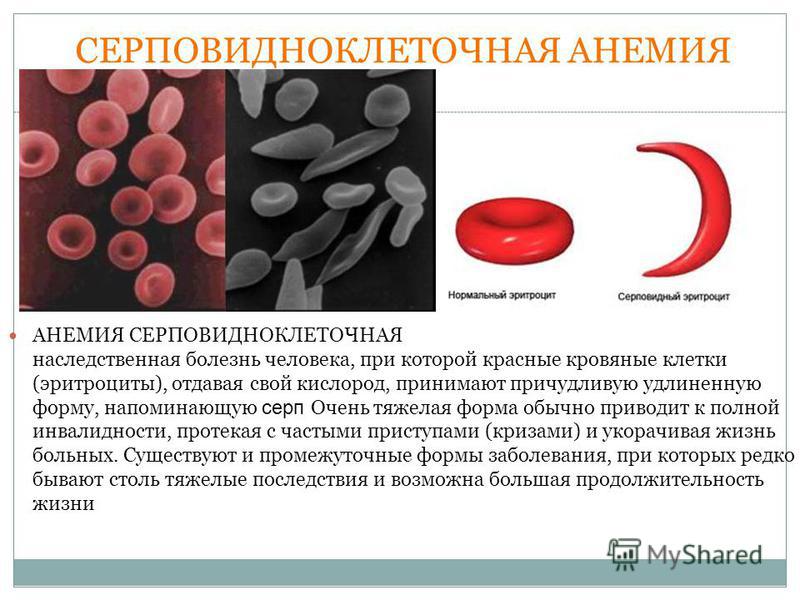 СЕРПОВИДНОКЛЕТОЧНАЯ АНЕМИЯ АНЕМИЯ СЕРПОВИДНОКЛЕТОЧНАЯ наследственная болезнь человека, при которой красные кровяные клетки (эритроциты), отдавая свой кислород, принимают причудливую удлиненную форму, напоминающую серп Очень тяжелая форма обычно приво