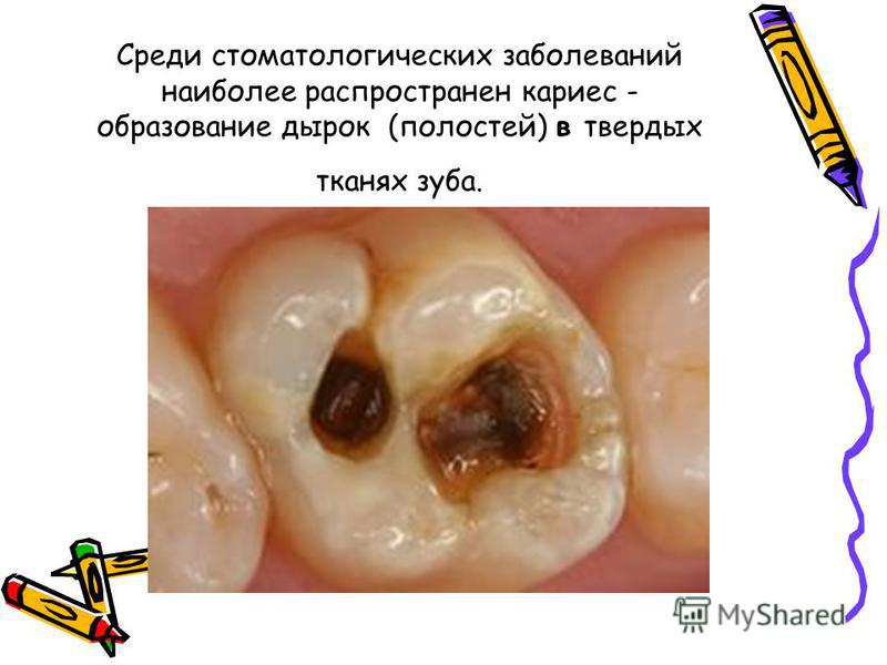 Среди стоматологических заболеваний наиболее распространен кариес - образование дырок (полостей) в твердых тканях зуба.