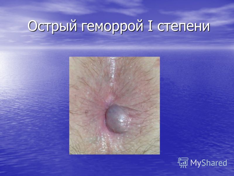 Геморрой кровоточит. Что делать Стоит ли паниковать